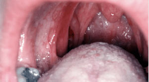 Oral Cancer Symptoms, Causes, and Prevention