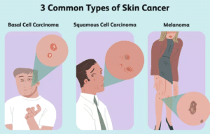 Skin Cancer: Types, Symptoms, Risk Factors & Treatment